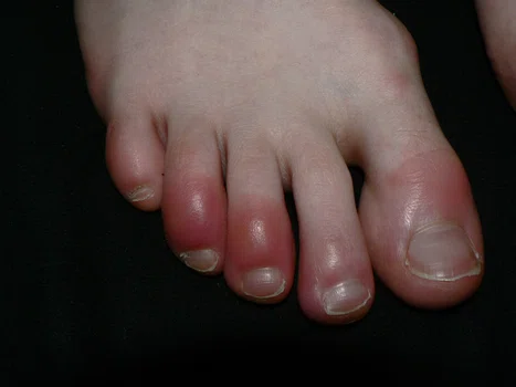 Easy ways to Cure Blood Blisters On The Little Toe?